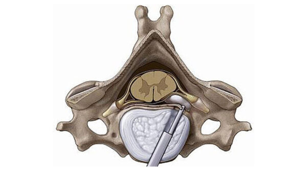 Комплект VERTEBRIS cervical anterior — изображение 2