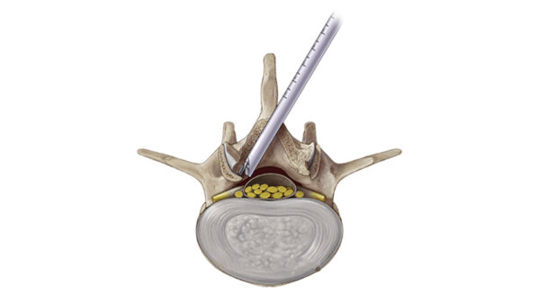 Комплект VERTEBRIS stenosis — изображение 3