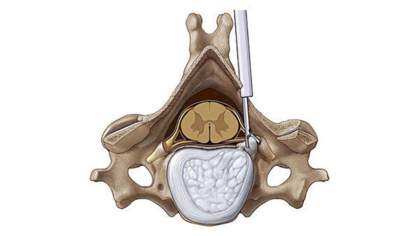 Комплект VERTEBRIS cervical posterior — изображение 2
