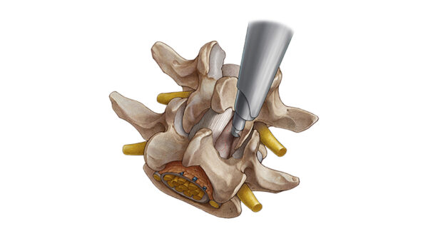 Комплект VERTEBRIS stenosis — изображение 2