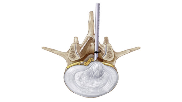 Комплект VERTEBRIS interlaminar — изображение 2